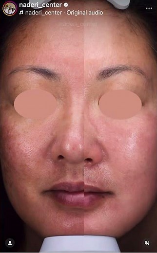 Non surgical skin tightening without the downtime ✨ #skintightening #morpheus8 #noninvasive