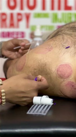 Dry Needling for Shoulder Tightness | Trigger Point Release