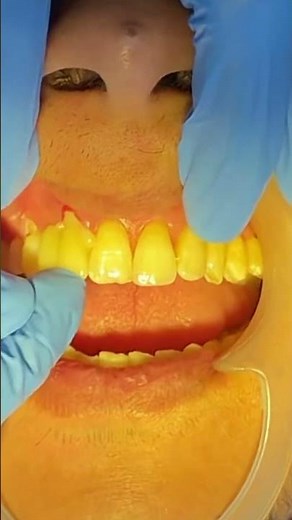 Cantilever Bridge (dental bridge)