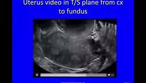 How to Preform Transvaginal Ultrasound
