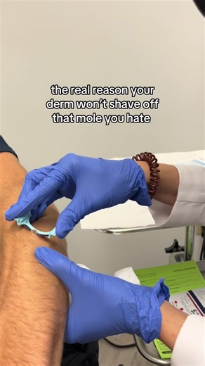 Understanding Mole Removal Options for Better Results