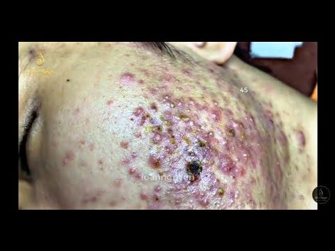 Severely Pus Filled Pimple Popping video || Extraction video