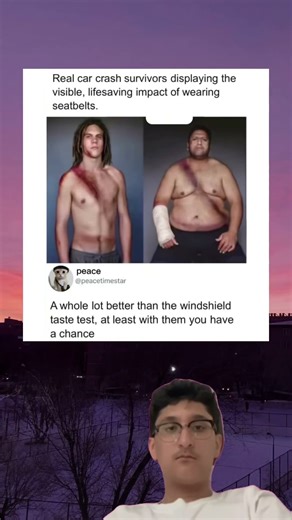 Real car crash survivors displaying the visible, lifesaving impact of wearing seatbelts.