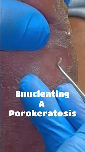 Enucleating A Porokeratosis