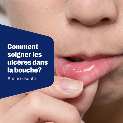 Nos astuces pour vous aidez à chasser les ulcères buccaux rapido presto! 💡 https://bit.ly/42gnPc0 | Jean Coutu