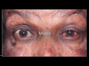 Ophthalmology module online " Kasr Al-Ainy" - 10 Acute Iridocyclitis& Acute Angle Closure Glaucoma