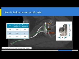 Planificación artroplastía de hombro en TAC 2D