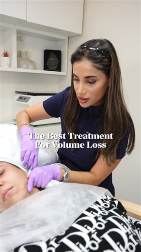 Achieving Natural Volume with Sculptra