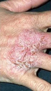 “Eczema Treatment | Skin Care Tips | Healthy Skin Starts Here | Treat | Heal Eczema