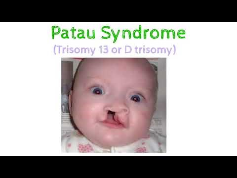 Patau Syndrome#Trisomy13#Anatomy#Genetics#Autosomalabnormalities