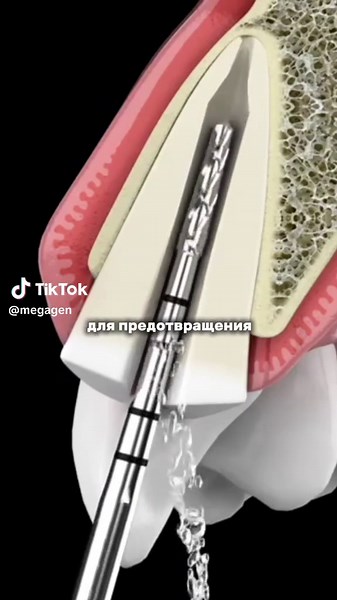 Socket Shield: Последствия и научные исследования