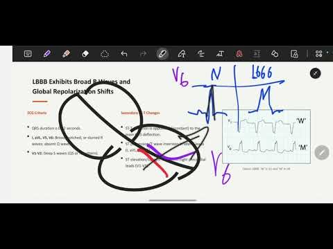 Bundle Branch Block (BBB) | Finally Makes Sense