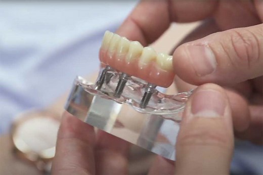 How Many Implants Are Needed for Full Mouth Replacement?