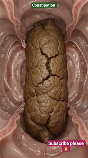 Constipation Explained | Causes, Symptoms of Constipation