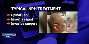 eShunt: Minimally invasive surgery for NPH