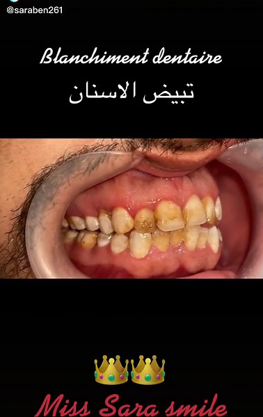 Teeth Whitening Transformation: Before and After Results