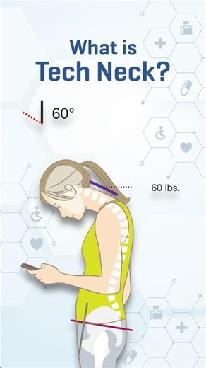 Tech Neck is Real and It Hurts #neckinjury #techneck #shorts