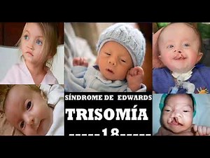 Síndrome de Edwars (Trisomía 18): Factores genéticos y ambientales