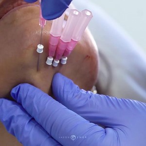 NovaThreads for Skin Tightening on Jawline & Chin