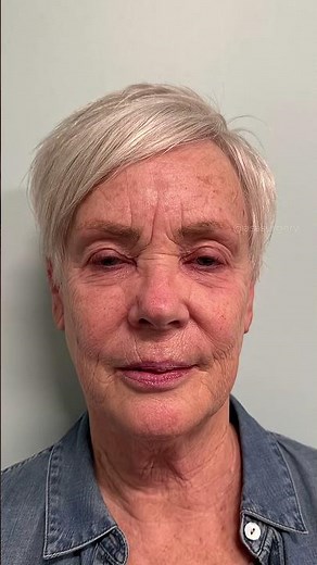 Contour TRL Before and After ⚡️