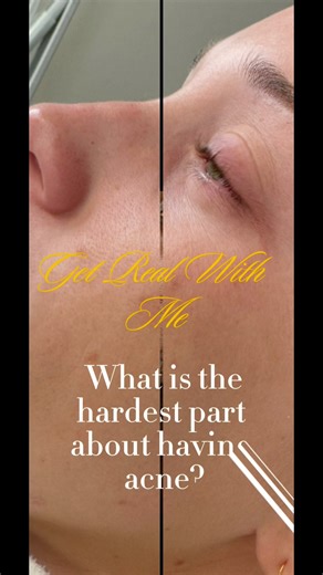 How Acne Affects Your Confidence — Esthetician Explains