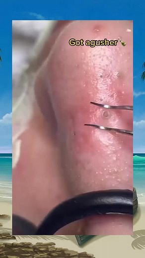 popping satisfying acne viral pimple squeeze pimplepop foryou (115)