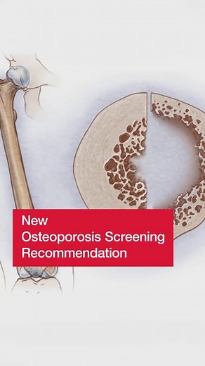 The US Preventive Services Task Force has released updated guidelines for osteoporosis screening, which now defines screening as a specific method of x-ray bone density testing, with or without fracture risk assessment. JAMA recognizes the importance of providing clinicians with timely and accessible resources to facilitate the implementation of these recommendations. Access JAMA's comprehensive analysis of the updated guidelines, including: ▪️ A detailed breakdown of the recommendations. ▪️ Exp