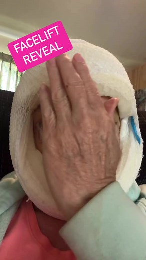 Facelift gone wrong? #facelift #facialsurgery | Hospicenursepenny