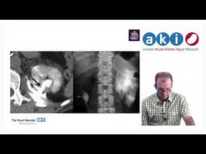 Ureteric Obstruction