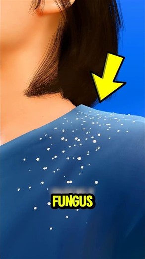 Dandruff Isn't Just Dry Skin... Here's What's Really Happening!