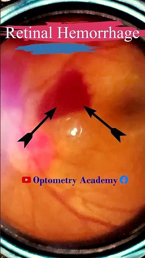 Retinal Hemorrhages | Eales disease | Fundus Photography | Short Video 94 #science