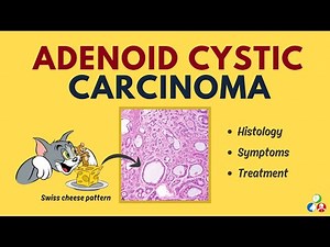 Adenoid Cystic Carcinoma - Perineural Spread | Histology | Clinical Features | Treatment