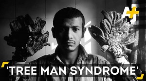 655K views · 8.1K reactions | Meet the first person with “tree man syndrome” to have his warts (successfully) removed. | AJ+ | Facebook