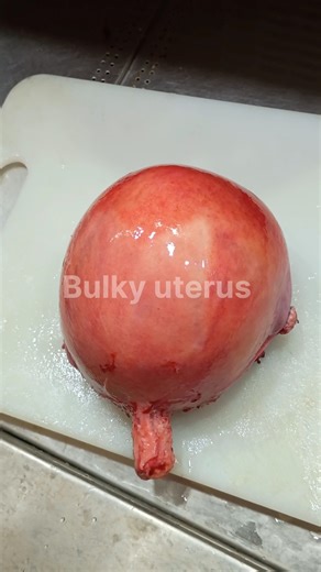 Bulky uterus specimen 😳| #uterineprolapse #fibroidremoval #fibroiduterus #fibroidtreatment #fibroid