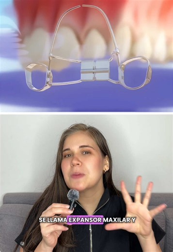 Esta es una forma de evitar extracciones para ordenar tu mordida, pero todo dependerá de tu caso y de un bue diagnóstico ☝🏻 #ortodoncia #brackets #dentista #viralvideo #limaperu🇵🇪