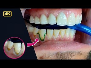 Class 5 Restoration - Gum Line Cavity Restoration