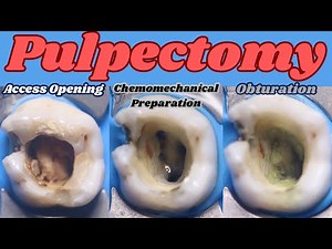Pulpectomy | Primary Maxillary Molar | 4 Canals | Step By Step Demonstration • Video • MEDtube.net