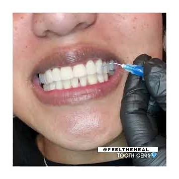 Tooth gem application live video