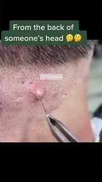 Removing large blackheads and pimples from face new 2026 #167