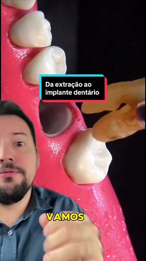 Da extração ao implante dentário: passo a passo
