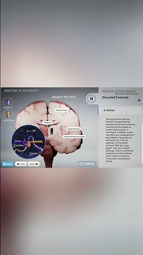 Understanding Chorea: Hyperkinetic Disorder #brain #interactivelearning #moa #mod #neurology