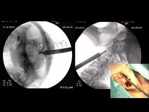 Odontoid Screw Fixation by Rick C. Sasso, M.D.