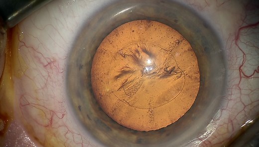 ZEISS OPMI LUMERA 300: Surgical LED microscope - cataract surgery