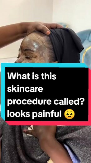 Traditional Skin Exfoliation Techniques and Sun Damage Prevention