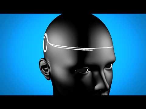 The Reed Procedure for Migraine & Headache Treatment Dallas Pain Specialist Dr. Ken Reed