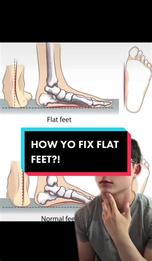 How to Fix Flat Feet: Tips and Remedies for Flat Foot Pain