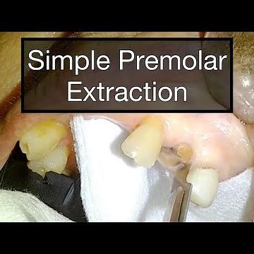 Simple Premolar Extraction Using the 15 Blade as my First Elevator