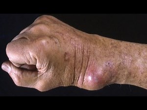 Valley Fever Symptoms- Flu Without Fever and Low Grade Fever - Coccidioidomycosis