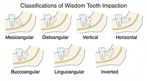 Wisdom Tooth Impaction in Ventura, CA - Pacific Oral Surgery