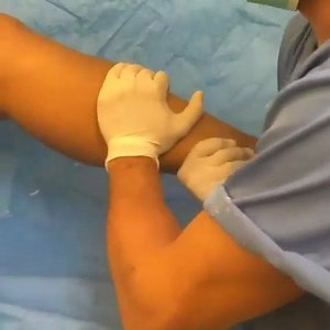 ACL rupture - One of the most common sport injuries. . #acltear #aclinjury #Physicaltherapy #physicaltherapist #physiotherapy #physiotherapist #physio #ACL #DPT #PT | Physical Therapy World